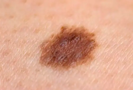 Melanoma